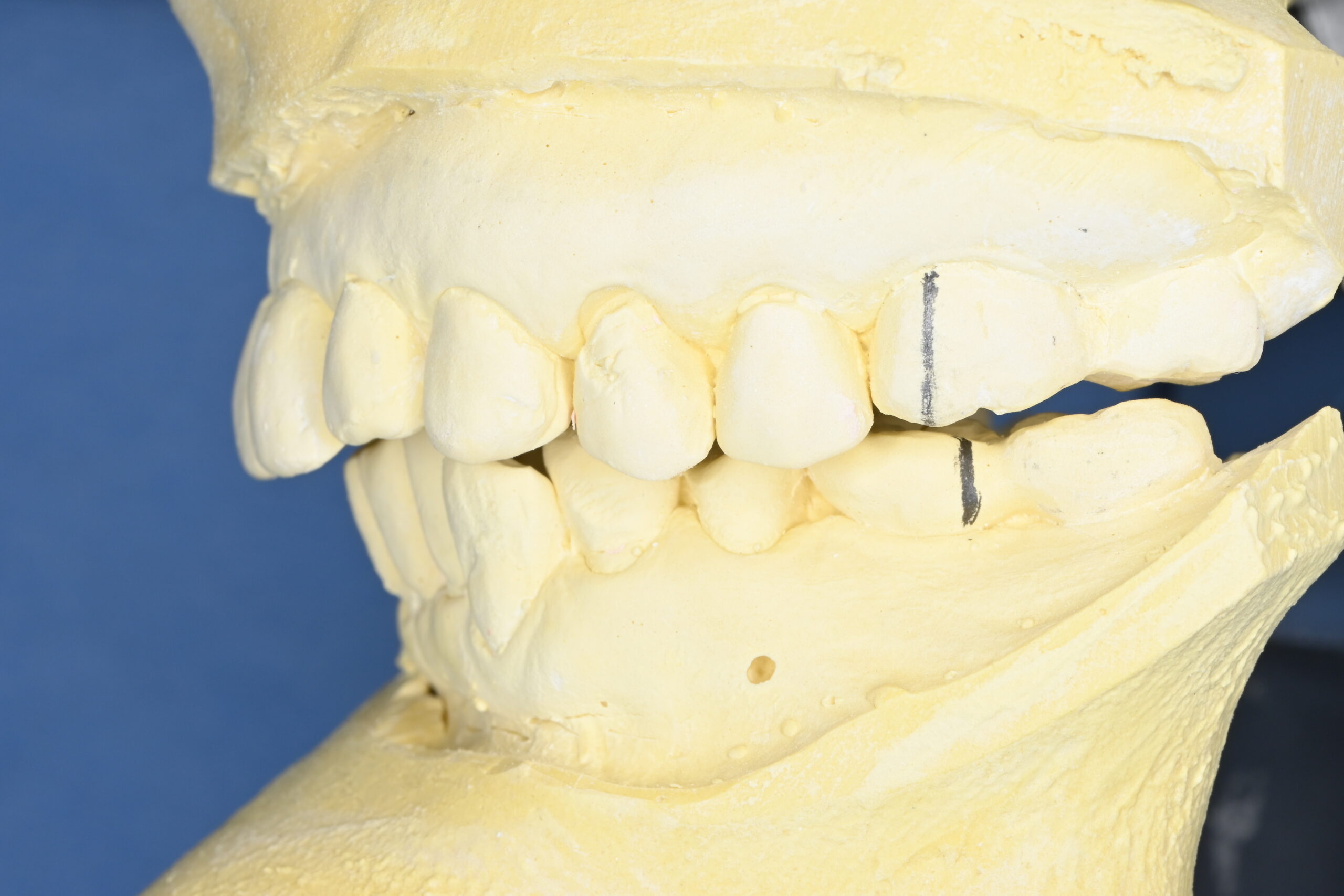 術前に咬合器に模型を装着し、咬合診査を行う　ずれの確認