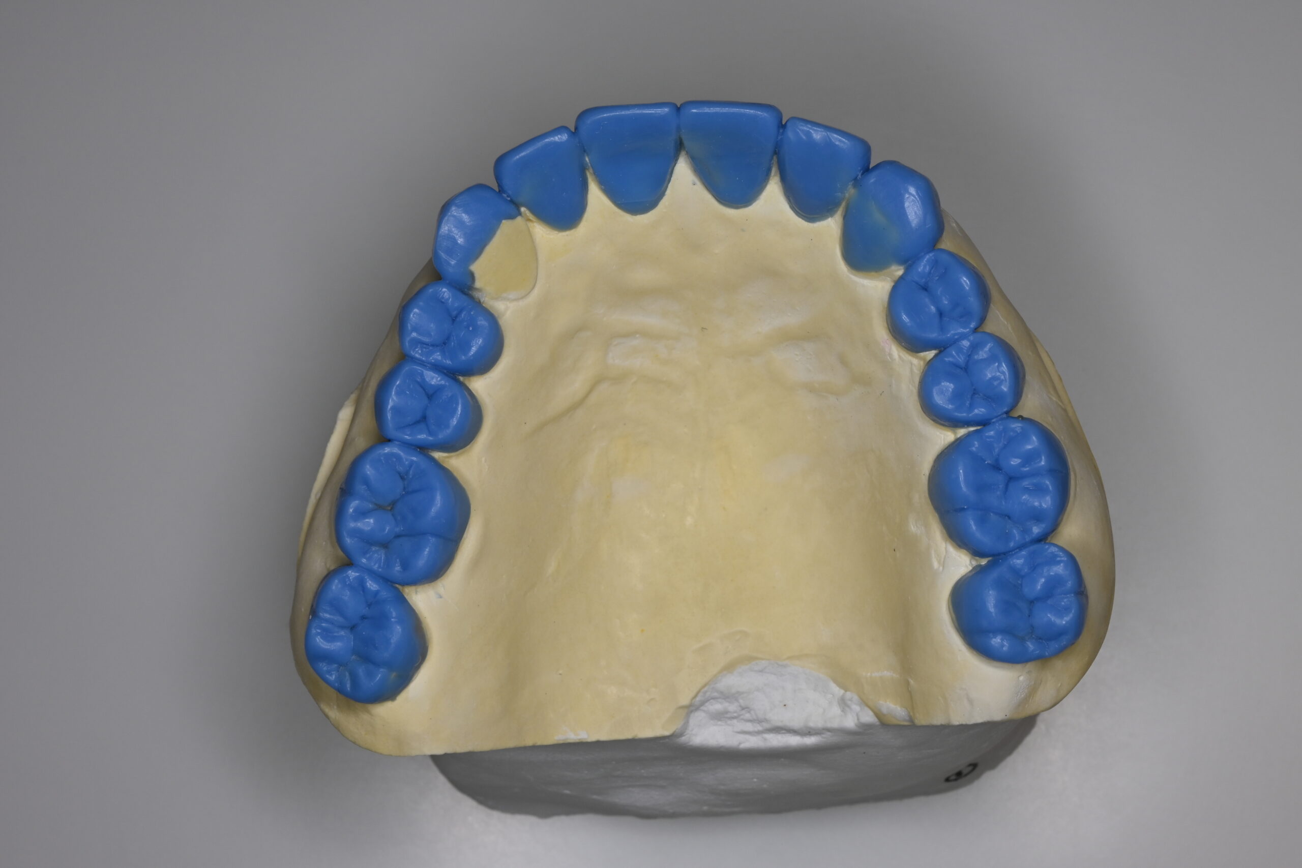 治療計画を立案し、診断用wax-upを作製　上顎の様子